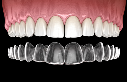 INVISALIGN