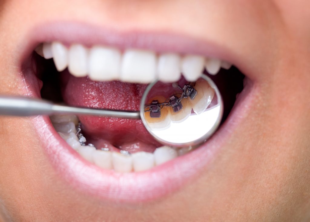 Braces being shown behind a patient's teeth