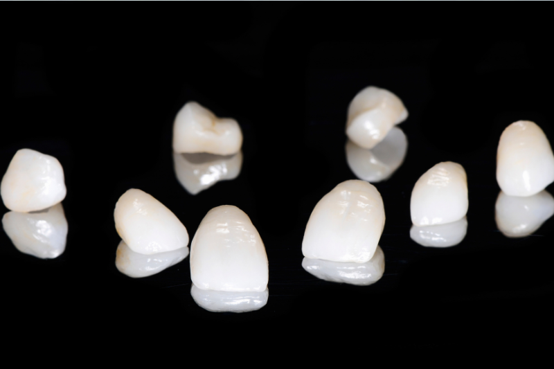 Veneers vs Braces Which is Better?