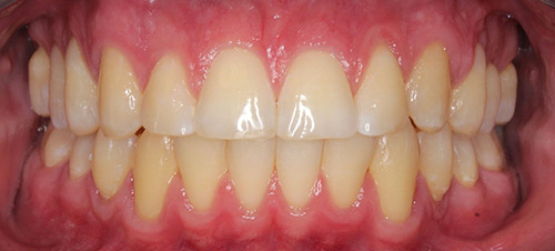 impacted canine
