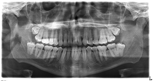 impacted canine
