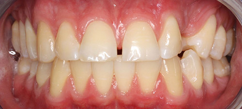 impacted canine