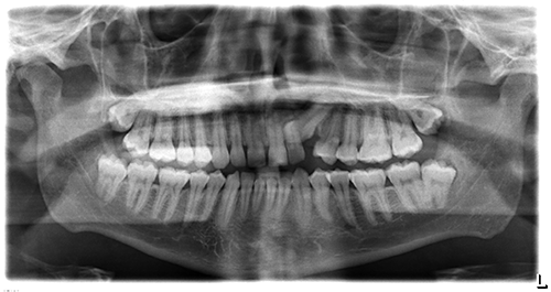 impacted canine
