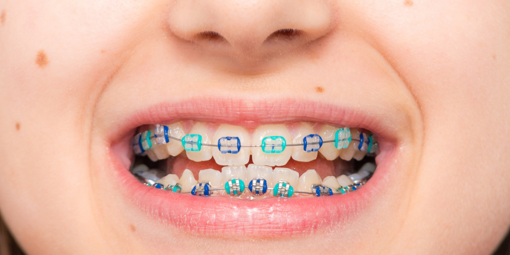 Can You Chew Gum With Braces Or Invisalign? (What Type)