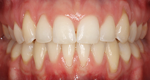 after orthodontic treatment