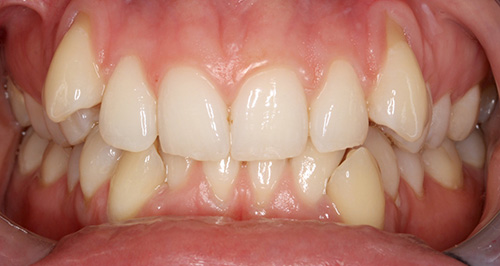 before orthodontic treatment