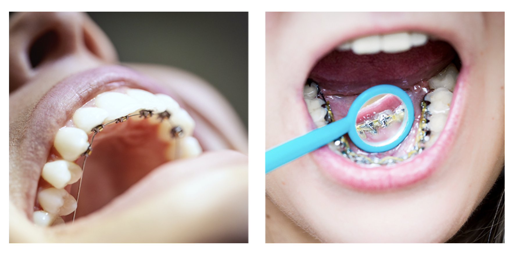 lingual braces