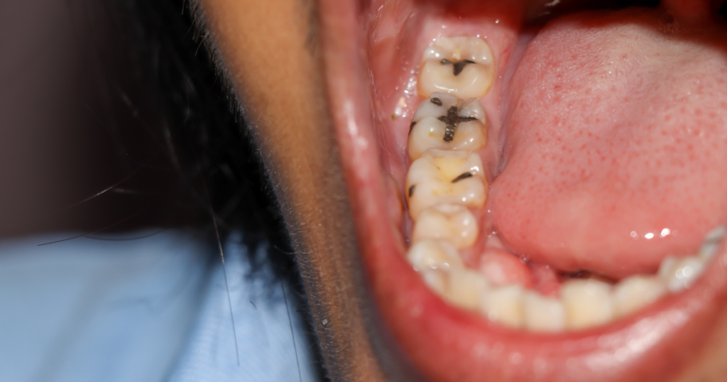mouth with cavities