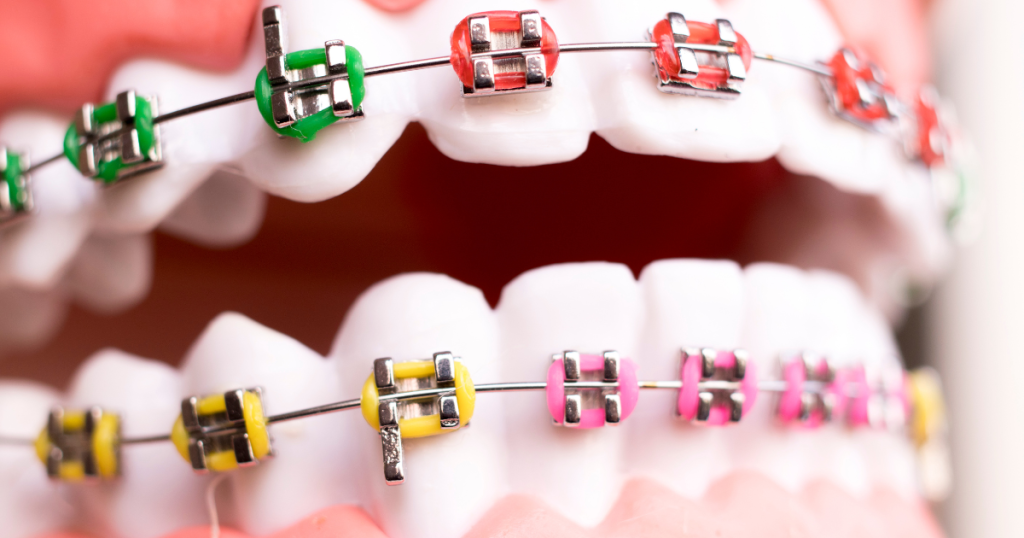 braces