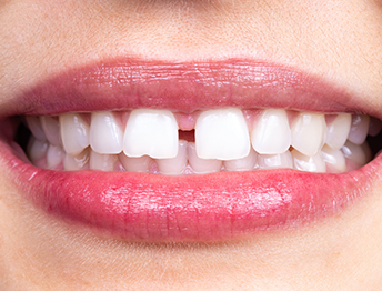 What orthodontic issues do ceramic braces correct?