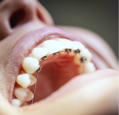 Types of Lingual Braces
