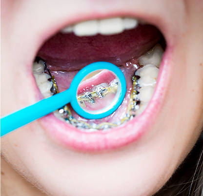 Types of Lingual Braces