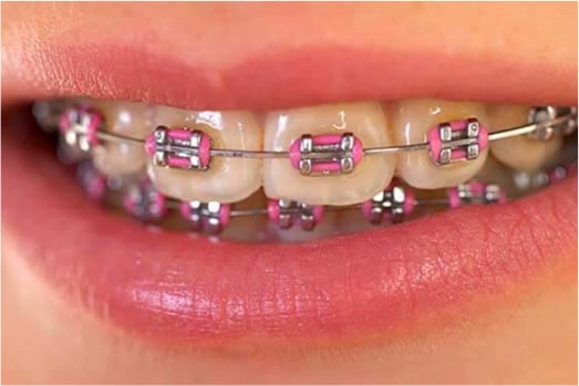 TRADITIONAL METAL BRACES